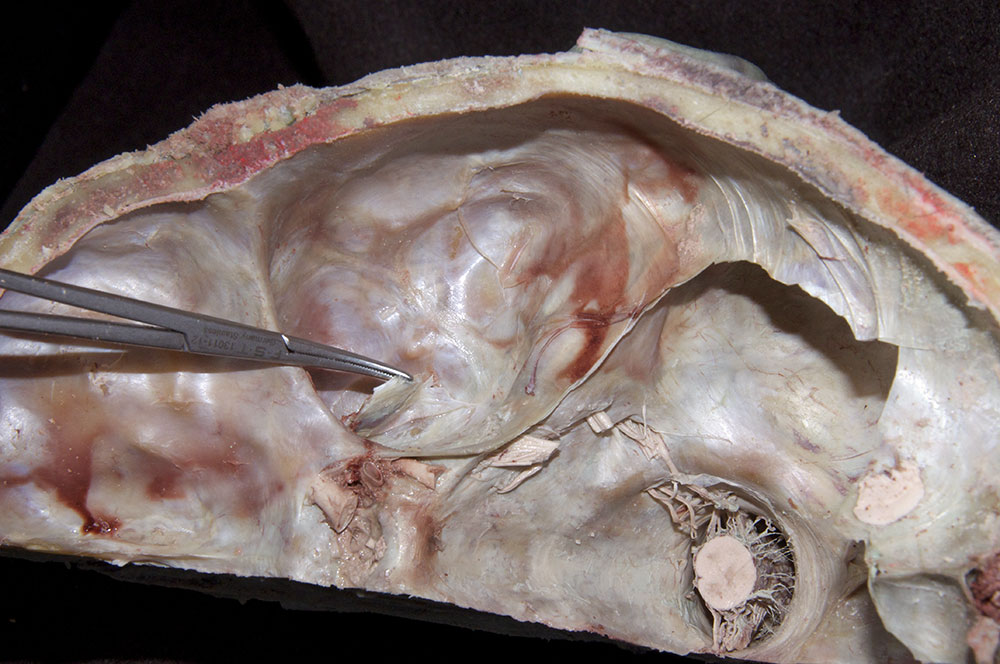 Stripping the Dura from the Trigeminal Ganglion