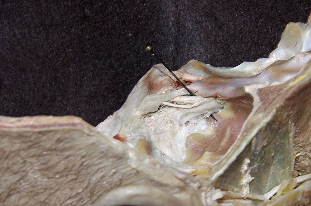 Trigeminal Ganglion