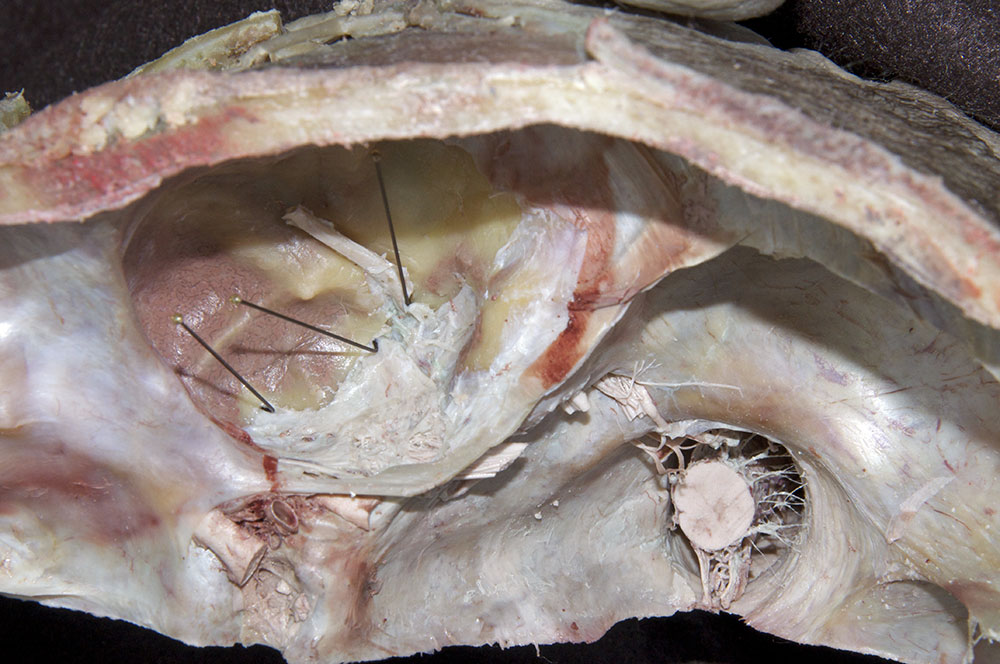 Mandibular Nerve