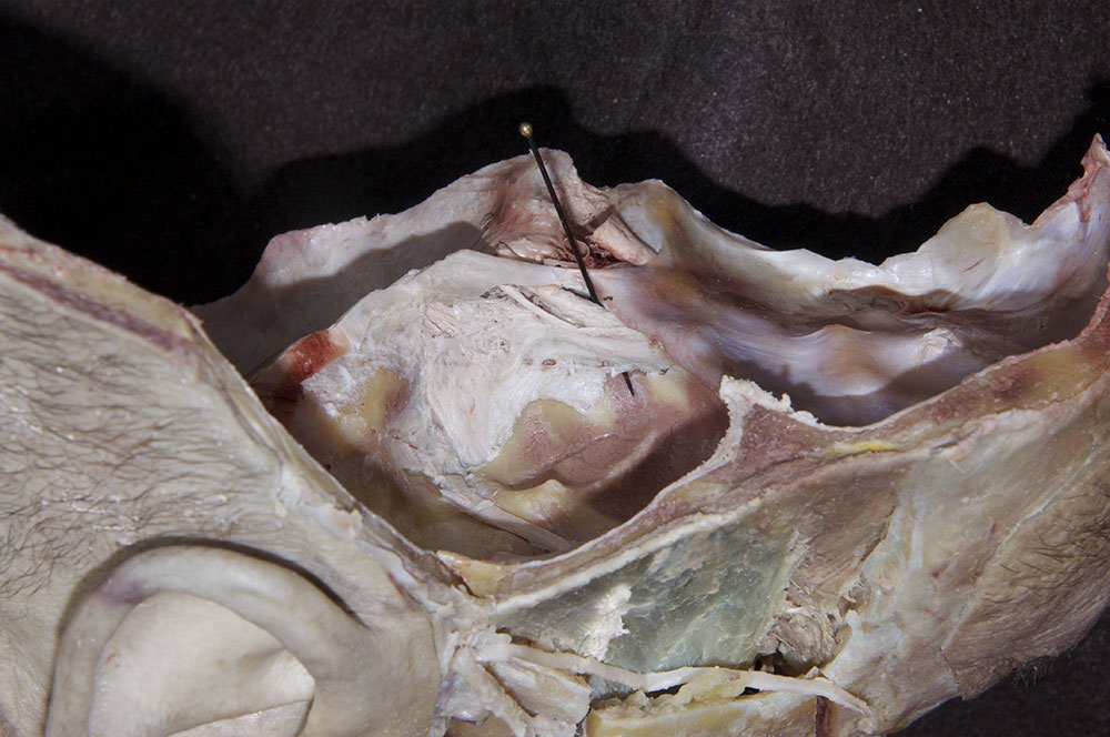 Ophthalmic Nerve