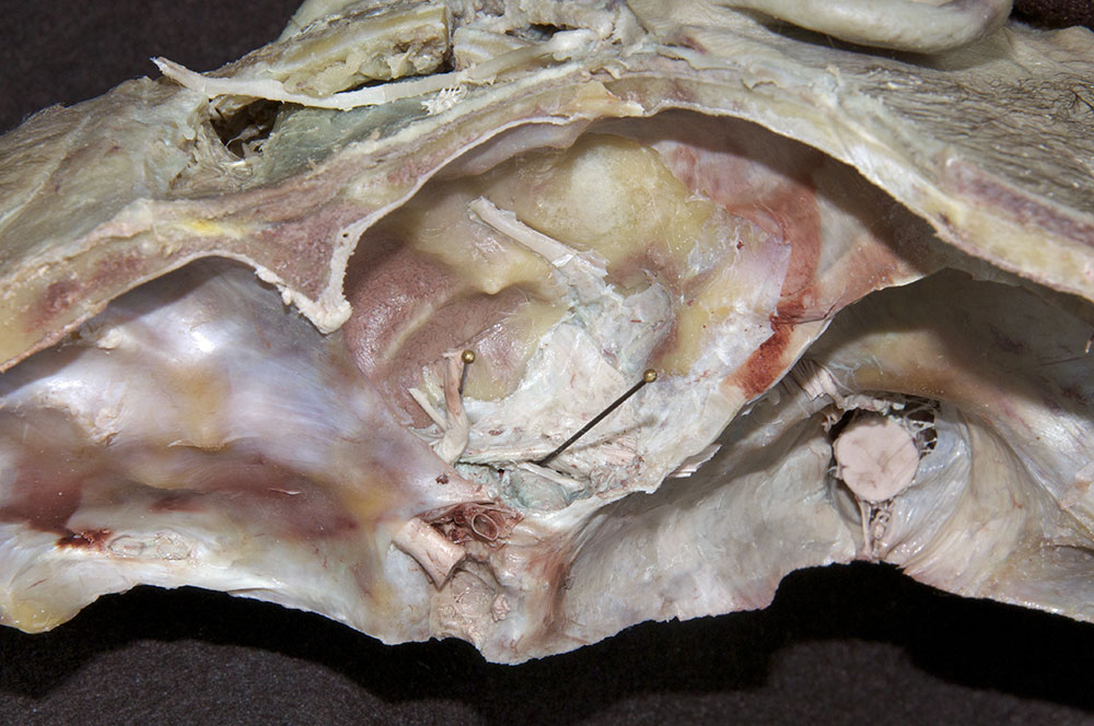 Internal Carotid Artery in the Cavernous Sinus