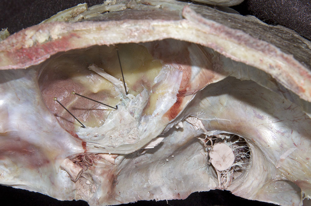 Middle Meningeal Artery