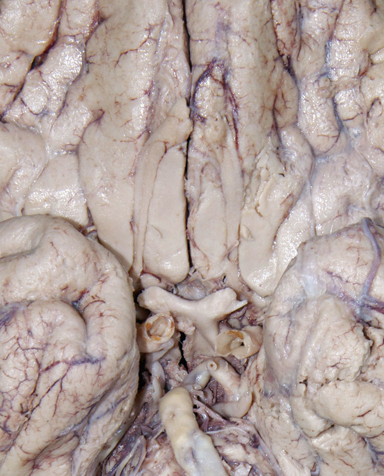 Olfactory Bulb and Tract