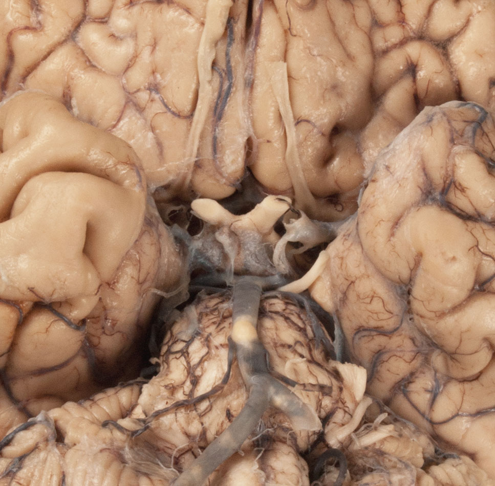 Oculomotor Nerve