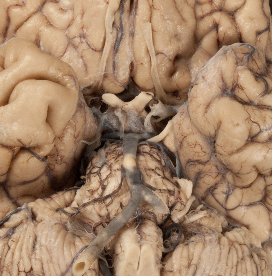 Basilar Artery