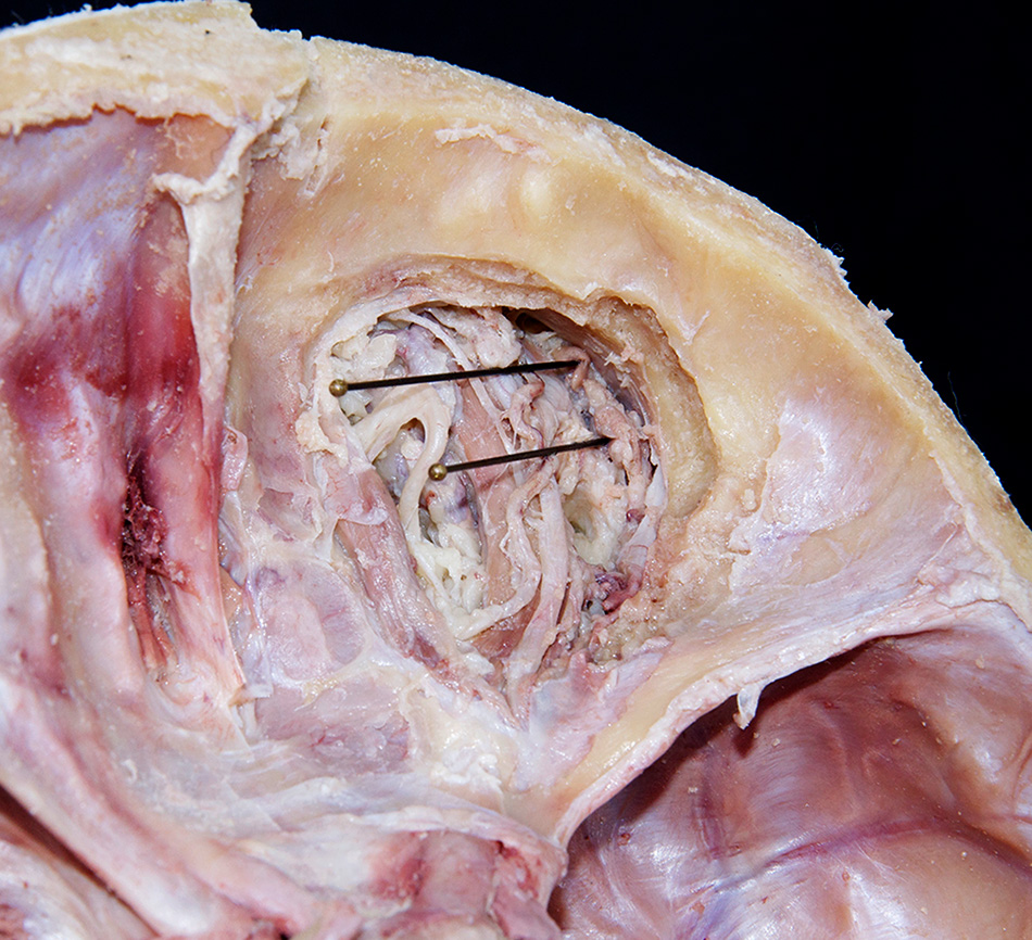 Lacrimal Gland