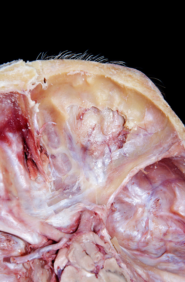 Orbital Periosteum