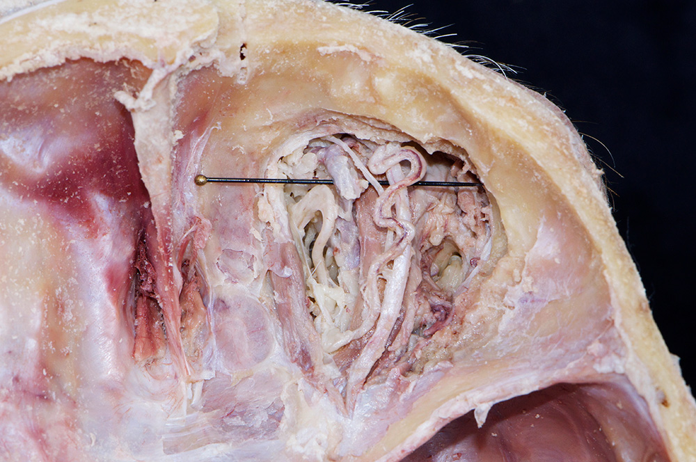 Frontal Nerve