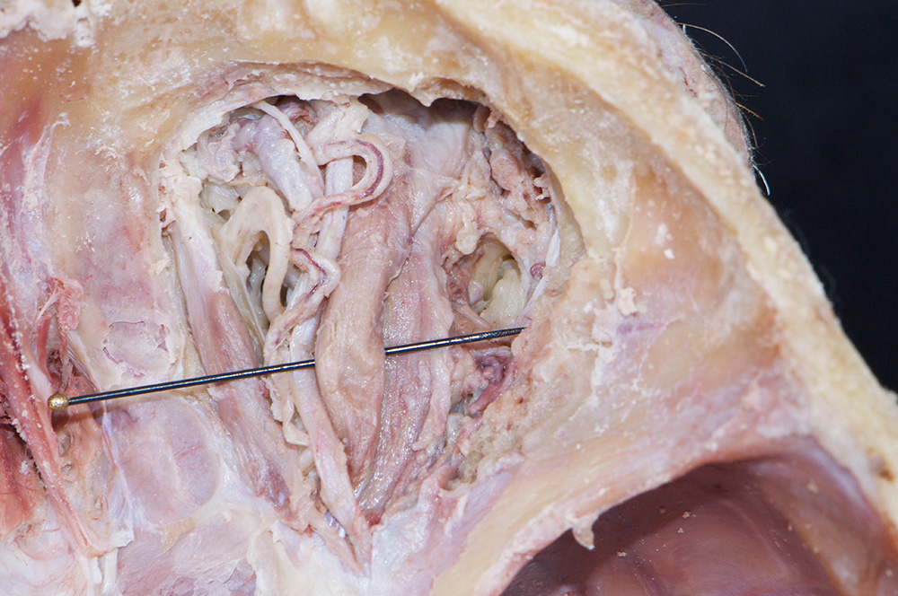 Oculomotor Nerve (superior ramus)