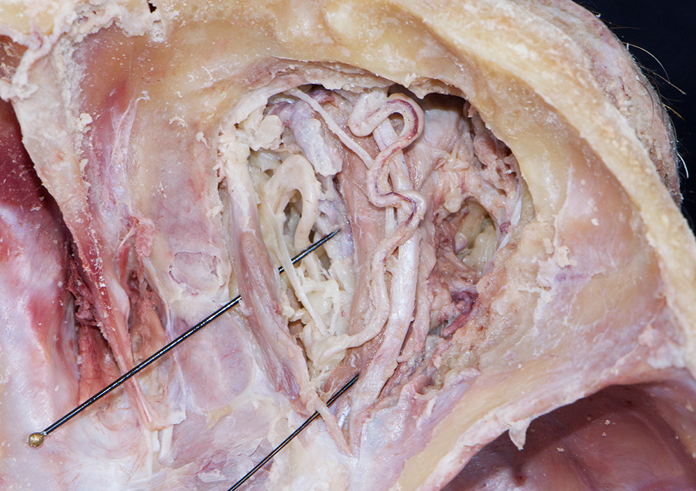 Superior Oblique Muscle