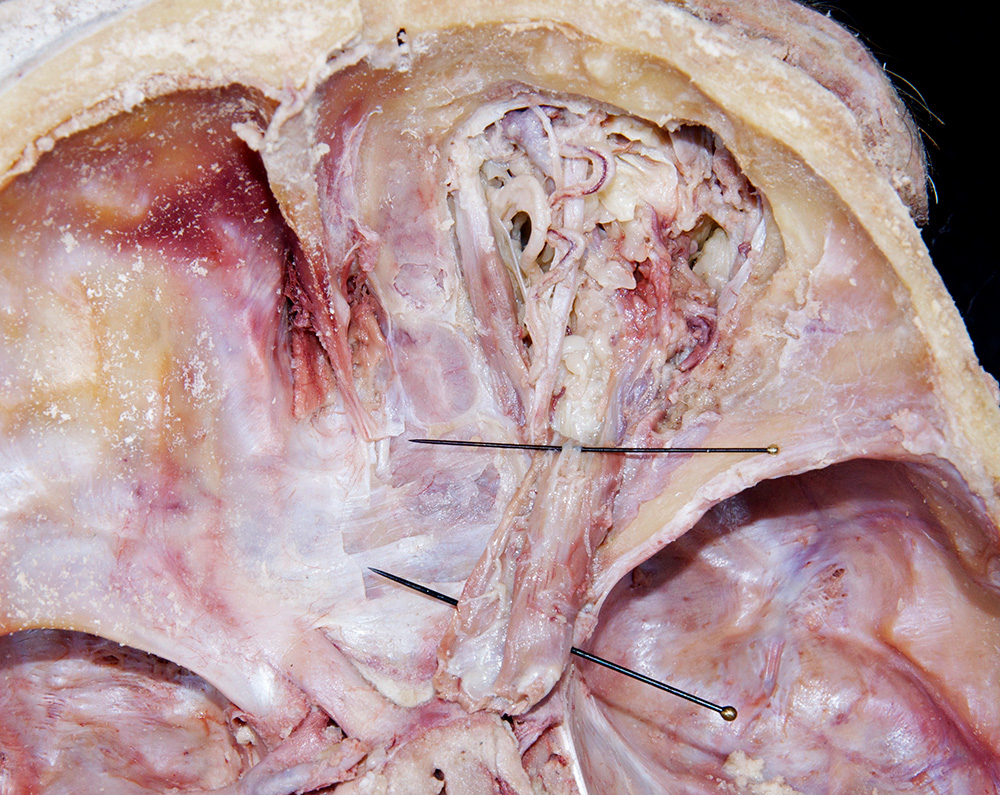 Oculomotor Nerve (superior ramus)