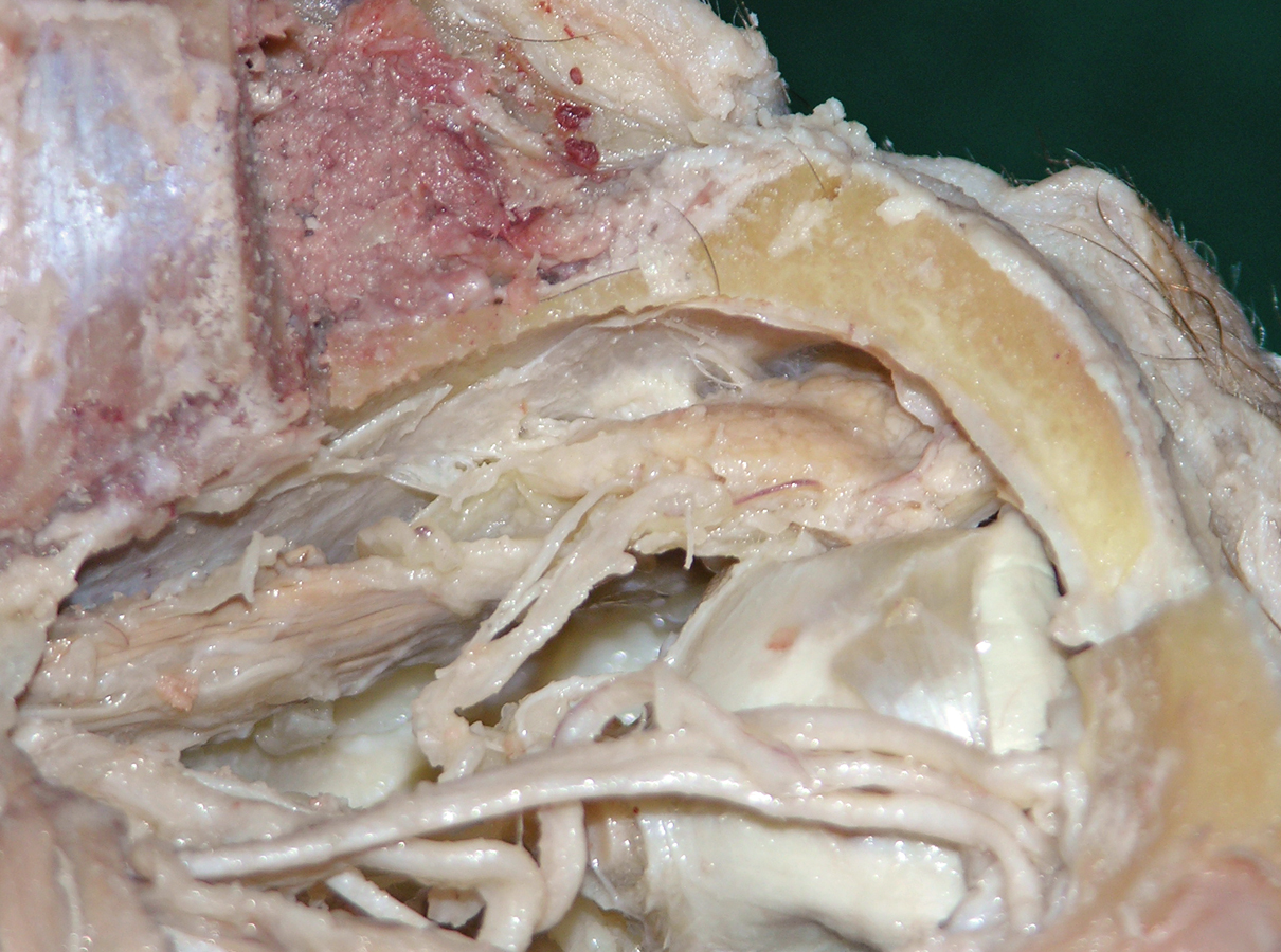 Lacrimal Nerve