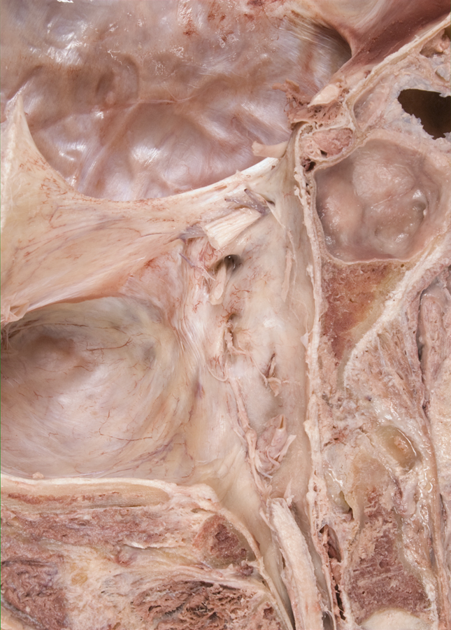 Left Cranial Cavity