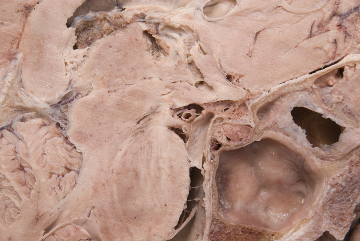 Posterior Cerebral Artery