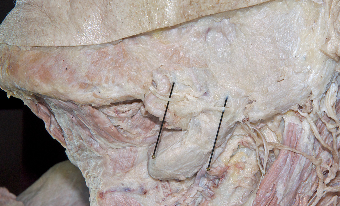 Facial Nerve (marginal mandibular branch)