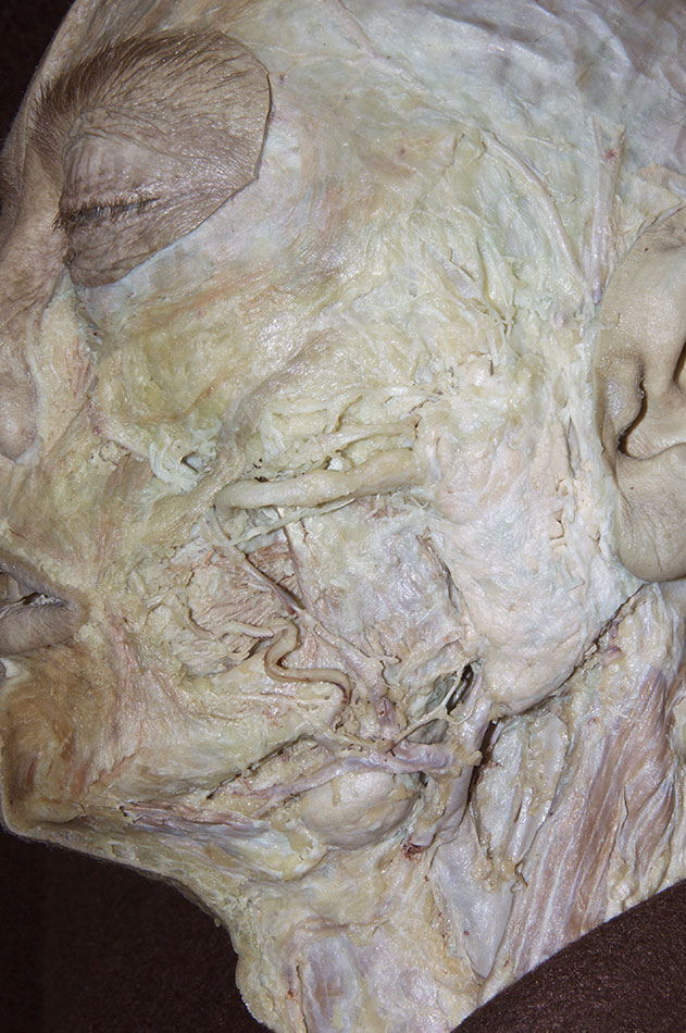 Parotid Gland