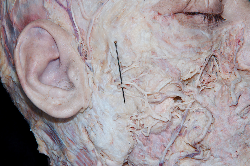 Transverse Facial Artery