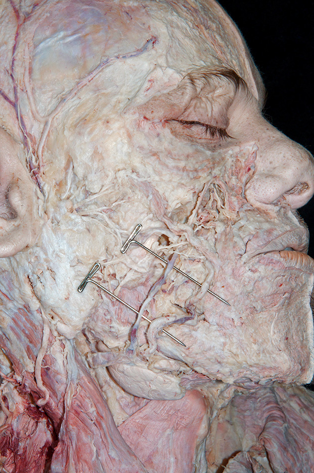 Facial Artery