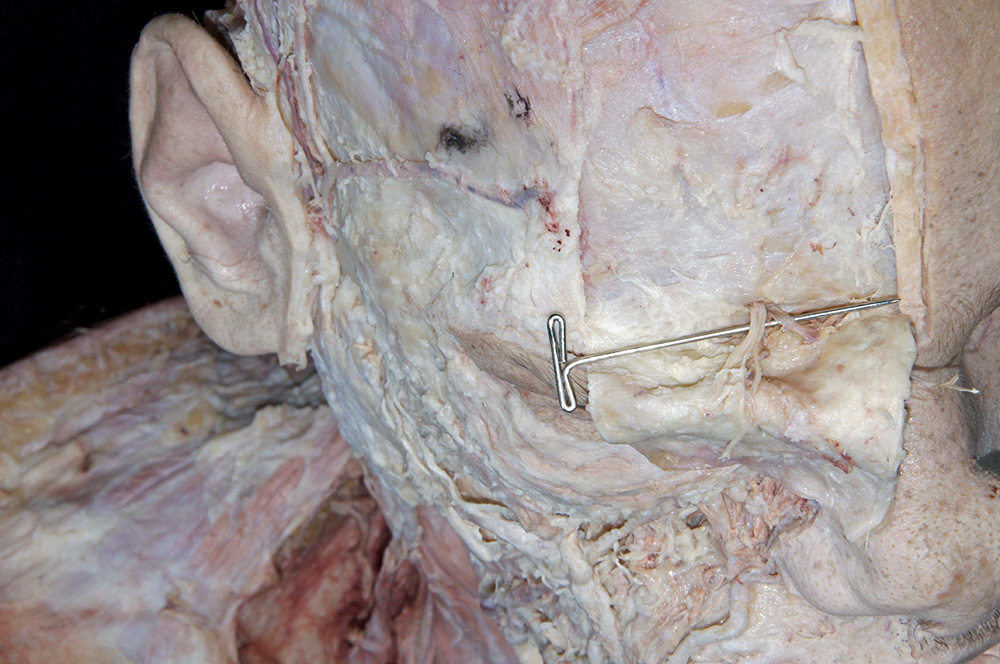 Supraorbital Nerve
