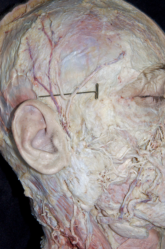 Superficial Temporal Artery