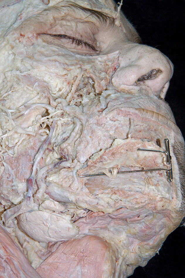 Mental nerve