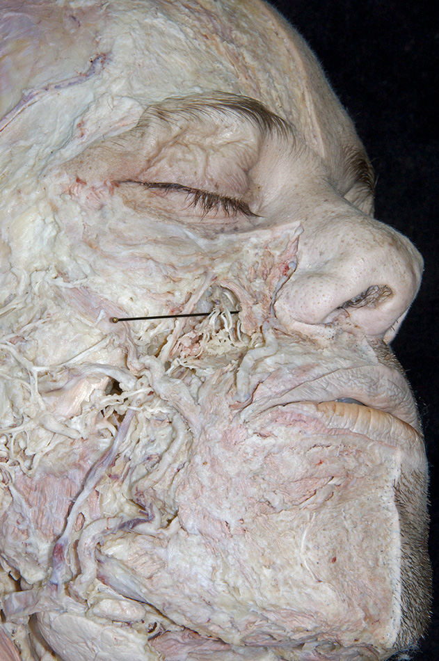 Infraorbital Nerve