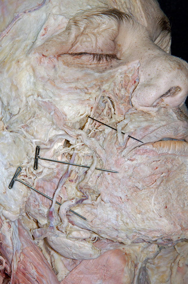 Superior Labial Artery