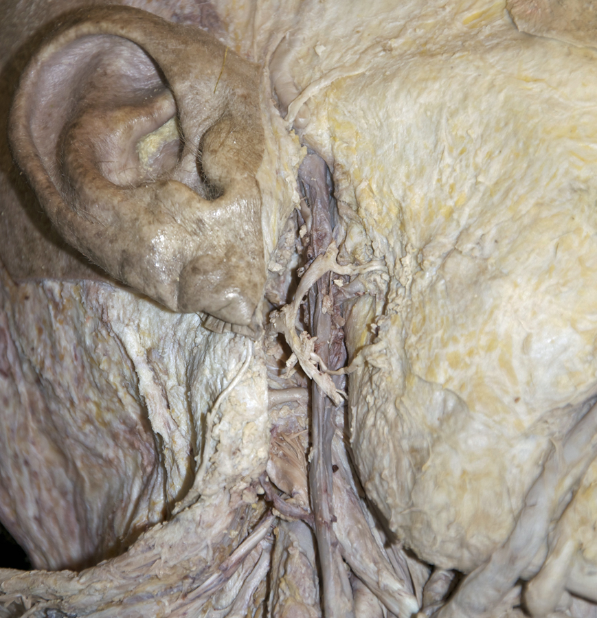 Superficial Temporal Vein (parotid gland removed)