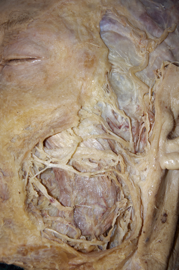 Facial Nerve Branches