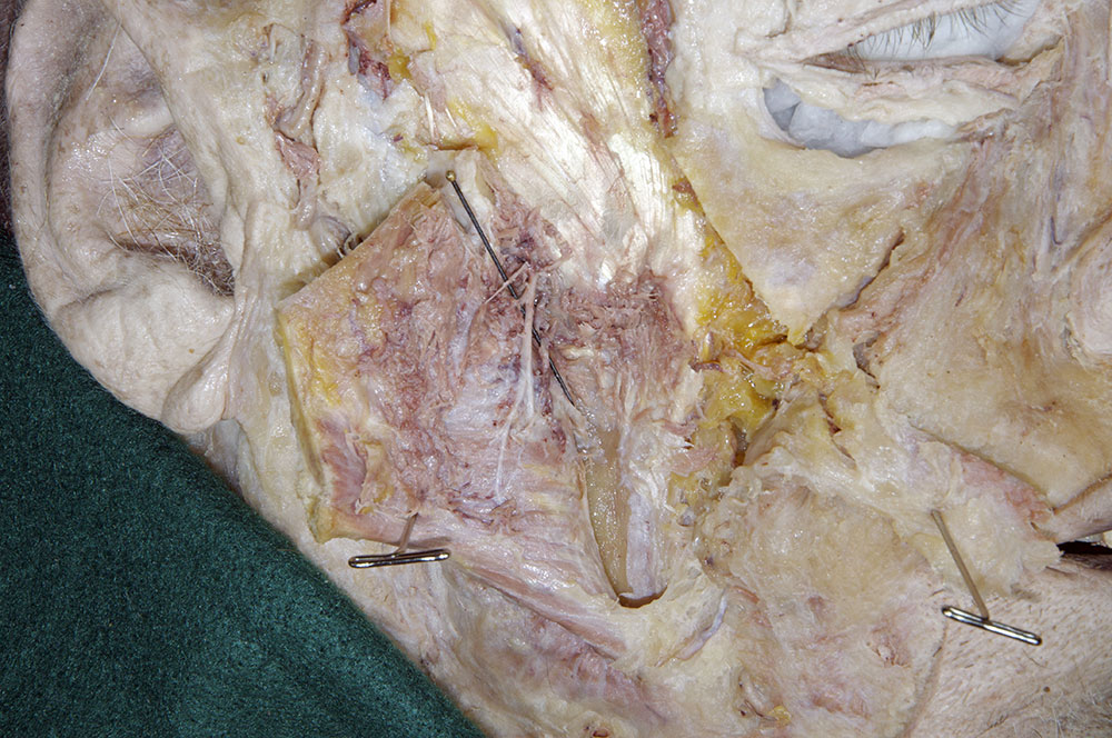 Masseteric Nerve and Artery