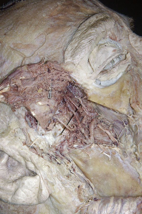 Maxillary Artery