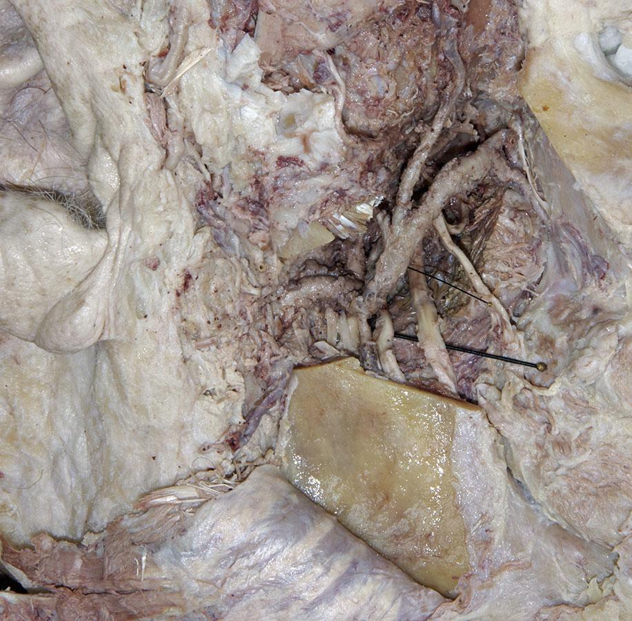 Inferior Alveolar and Lingual Nerves