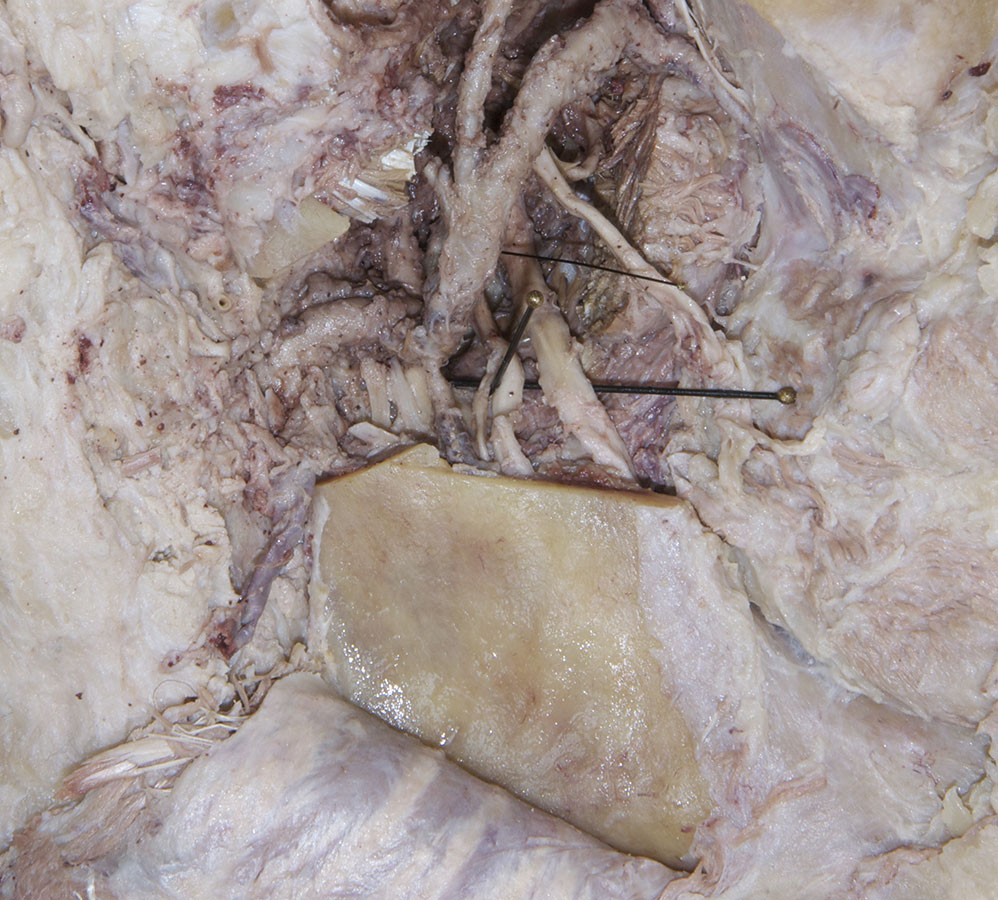 Mylohyoid Nerve
