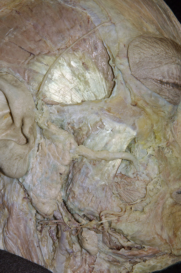 Masseter Muscle