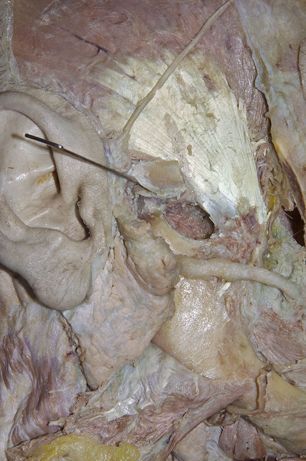 Articular Disc