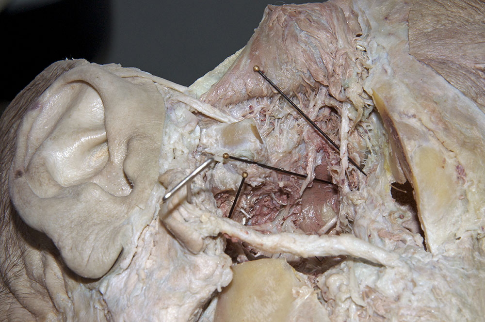 Deep Temporal Nerve and Arteries