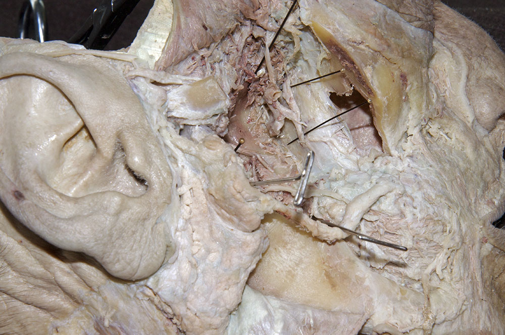 Maxillary Artery Entering the Pterygomaxillary Fissure