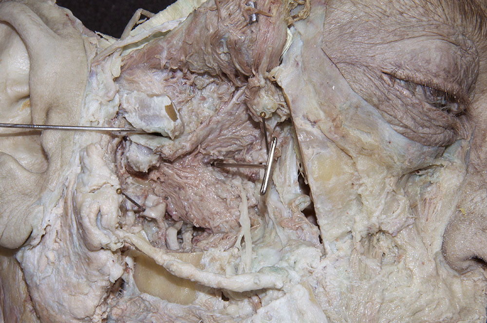 Lateral Pterygoid Muscle