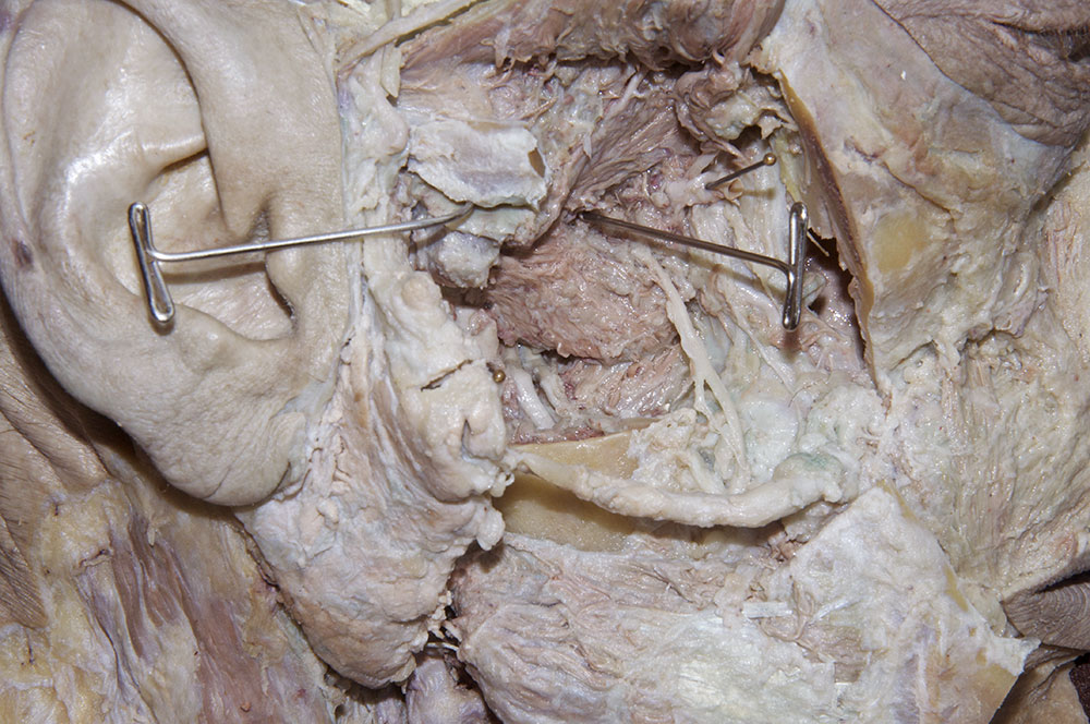 Medial Pterygoid Muscle