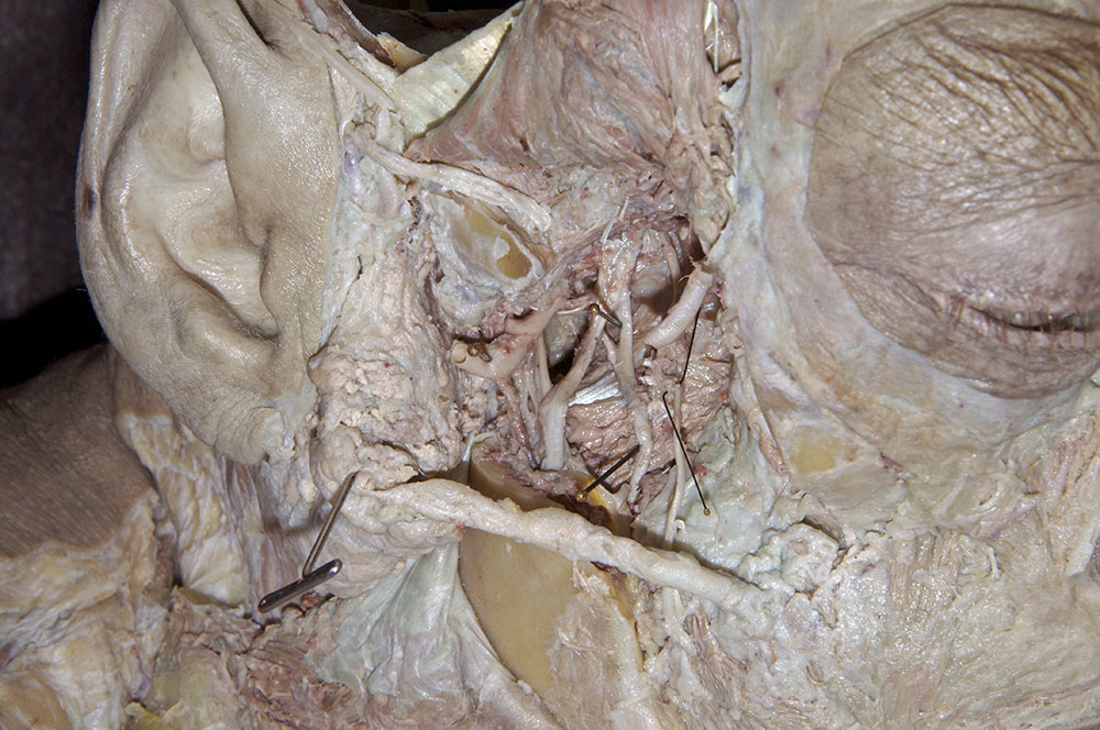 Chorda Tympani Nerve