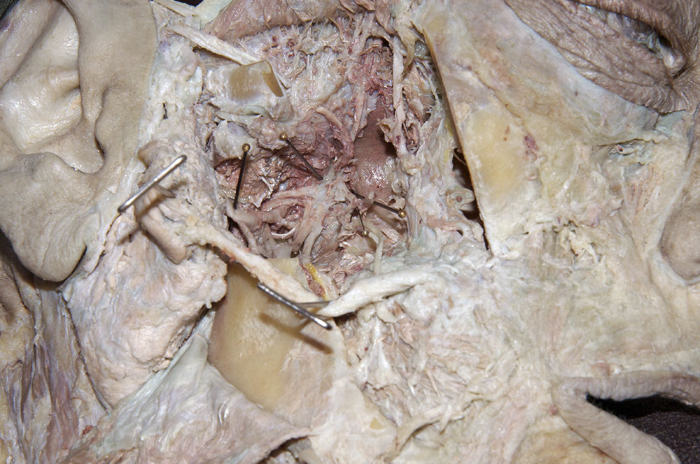 Mandibular Nerve Exiting Foramen Ovale