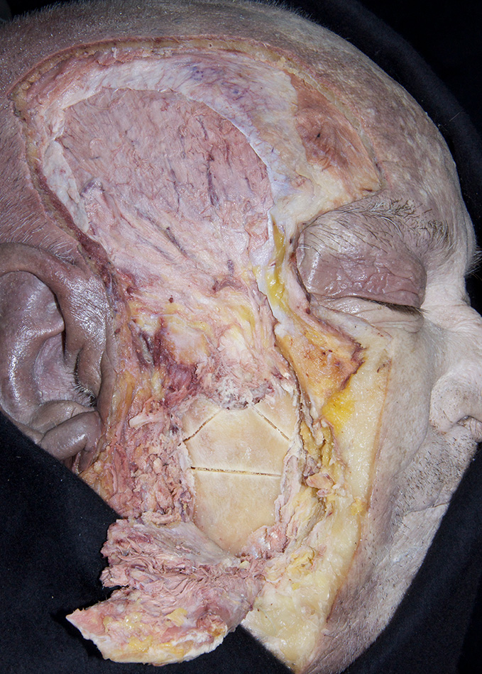 Mandible (saw lines)