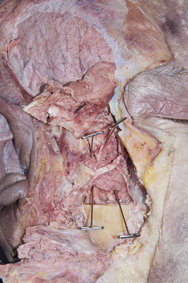 Lateral Pterygoid Muscle