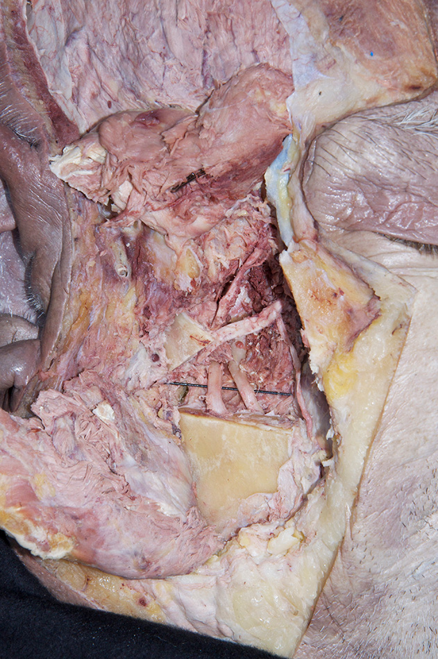 Lateral Pterygoid Muscle (partially removed)