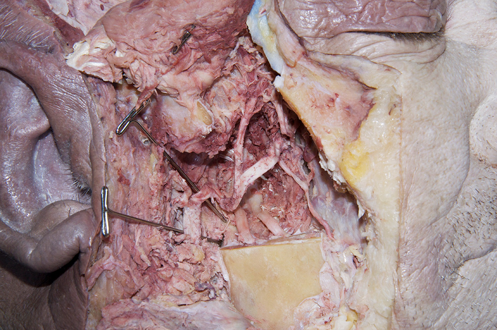 Maxillary artery