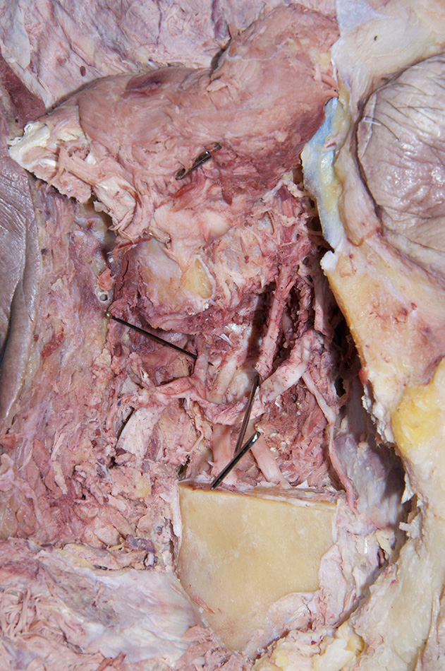 Middle Meningeal Artery