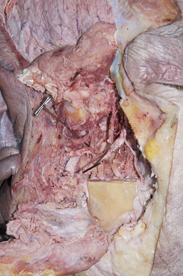 Auriculotemporal Nerve