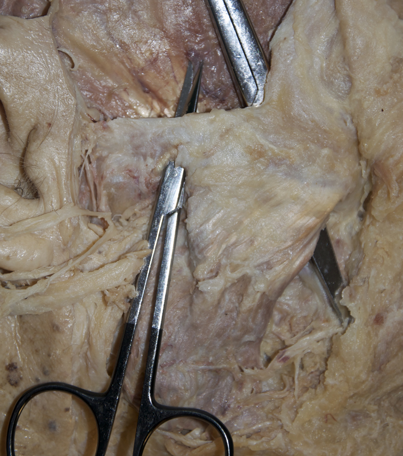 Zygomatic Arch