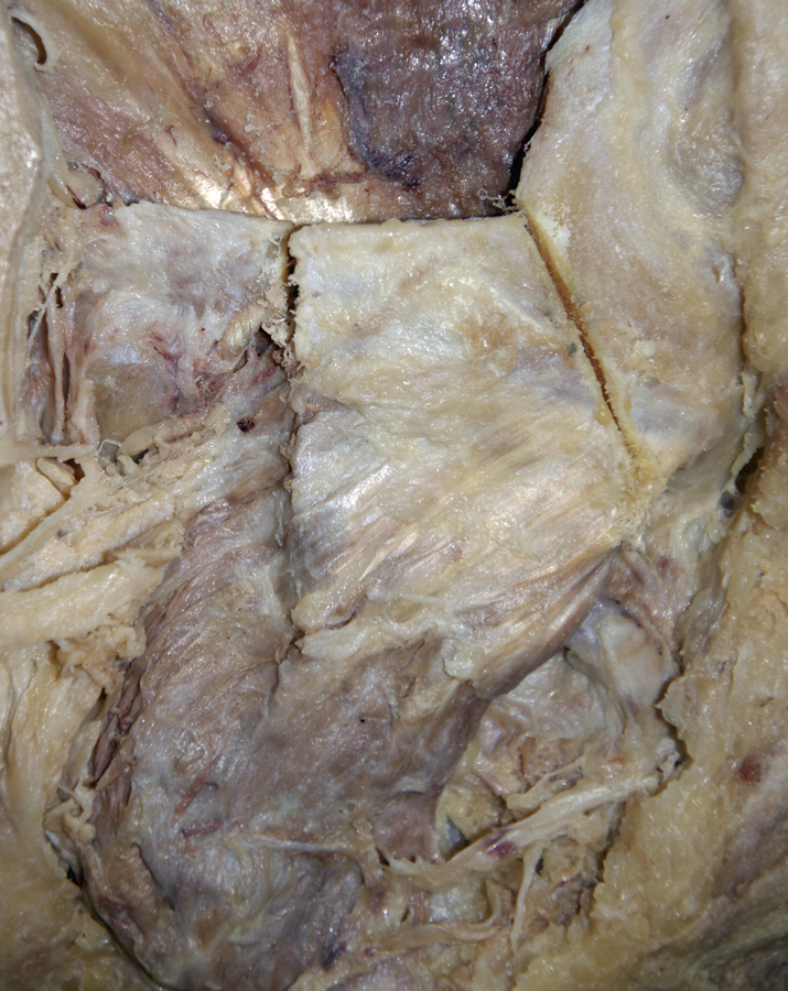 Zygomatic Arch (cut)