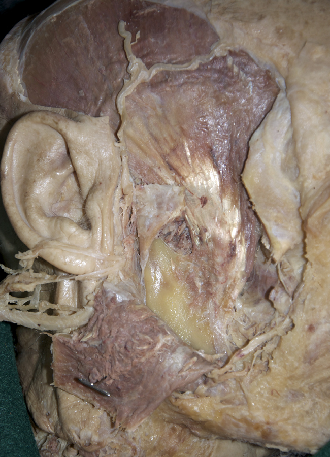 Masseter Muscle (reflected)